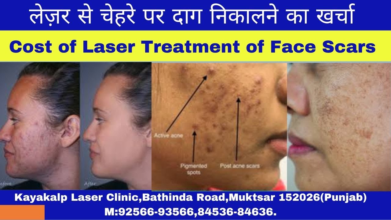 लेज़र से चेहरे पर दाग निकालने का खर्चा |  Cost of Laser Treatment of Face Scars