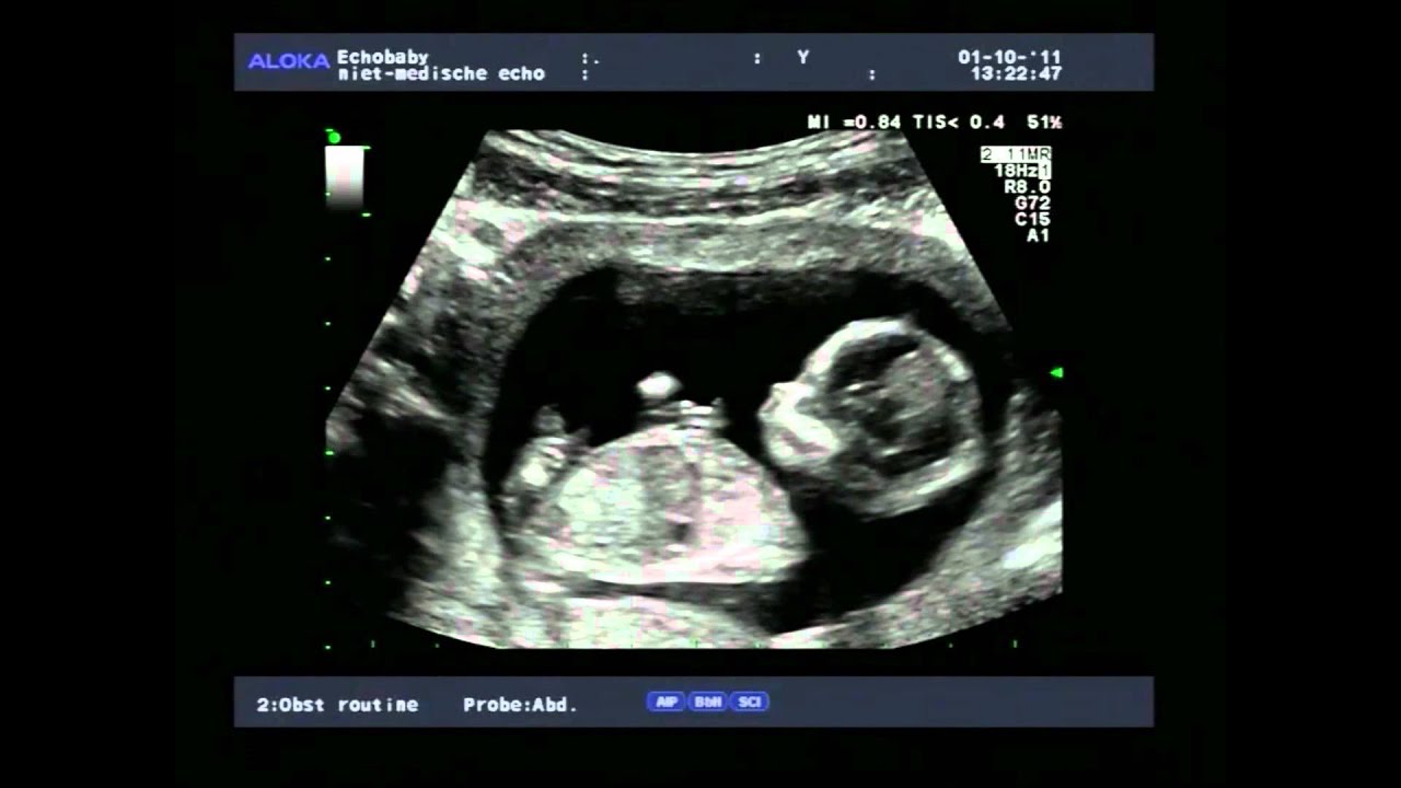 2D en 3D-echo 13 weken meisjes