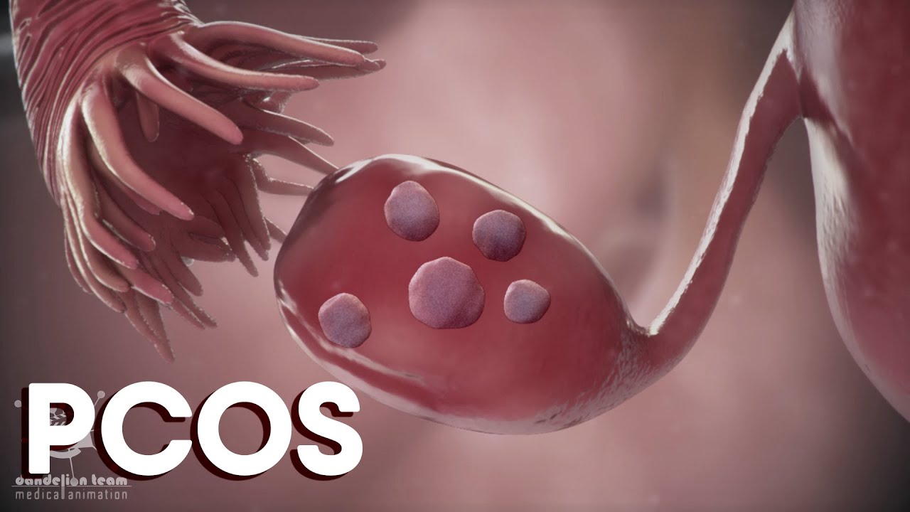 Miesiączka i zesp&oacute;ł policystycznych jajnik&oacute;w, czyli PCOS | Przyczyny | Leczenie | Animacja medycz...