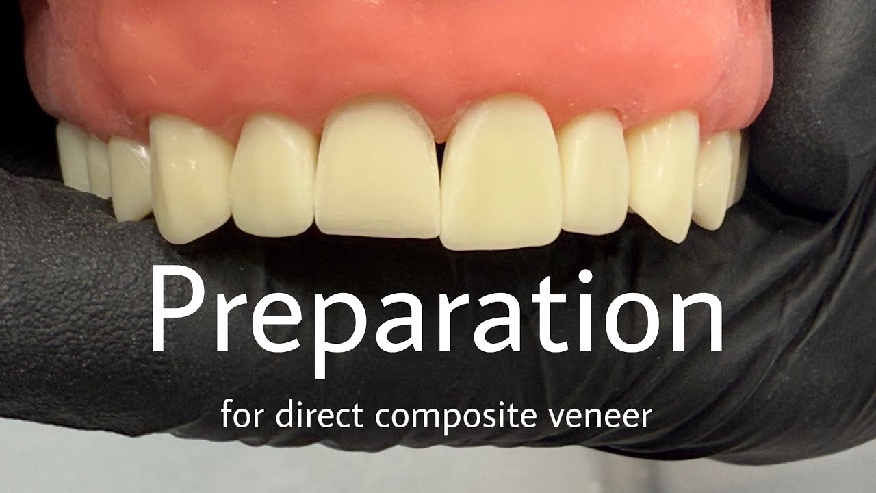 Preparation (direct composite veneer) آماده سازی دندان قبل از ونیر کامپوزیتی