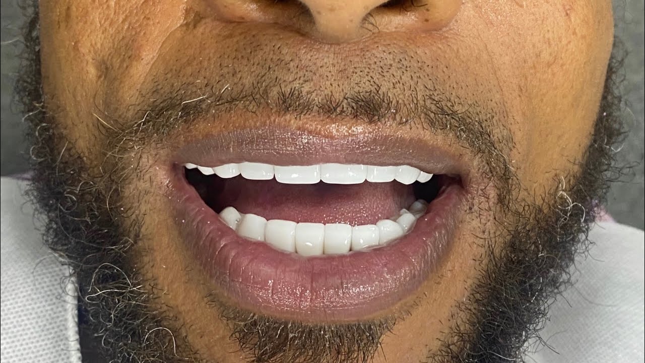 PORCELAIN VENEERS VLOG | BILLION DOLLAR SMILE | DR. MARIO MONTOYA