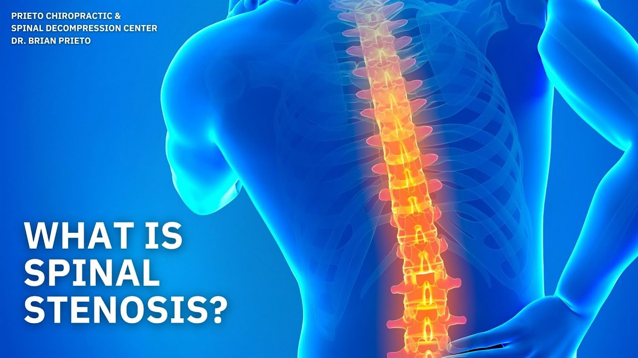 What Is Spinal Stenosis? Yorba Linda CA Chiropractor