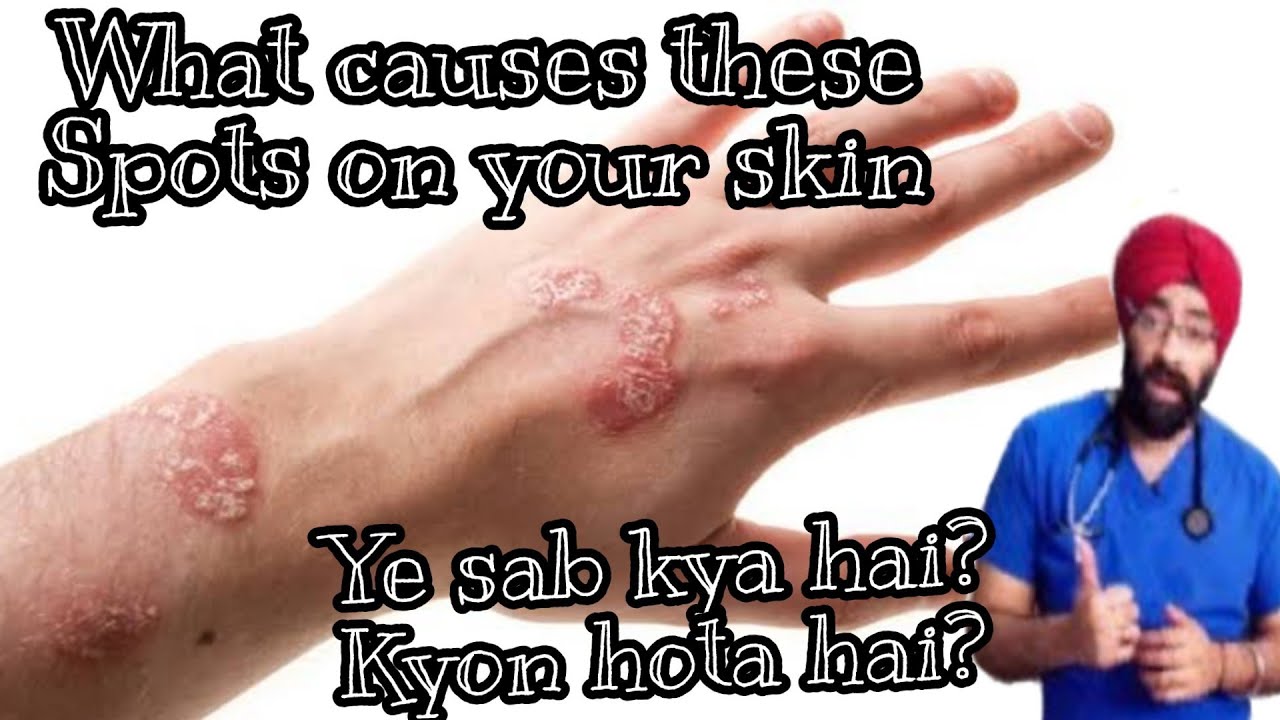 Psoriasis kyon hota hai? The Basic problem 100%Science |Dr.Education