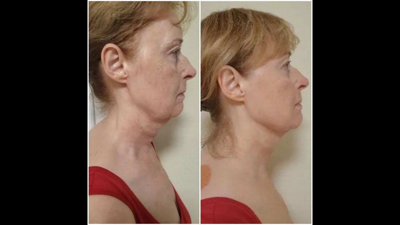 Resculpter les JOUES et RAJEUNIR son VISAGE efficacement