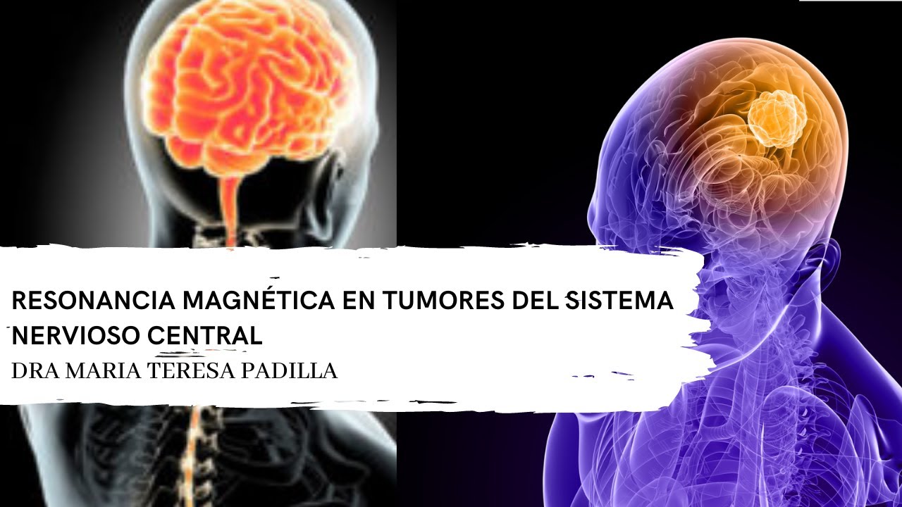 Resonancia Magnética en Tumores del Sistema  Nervioso Central