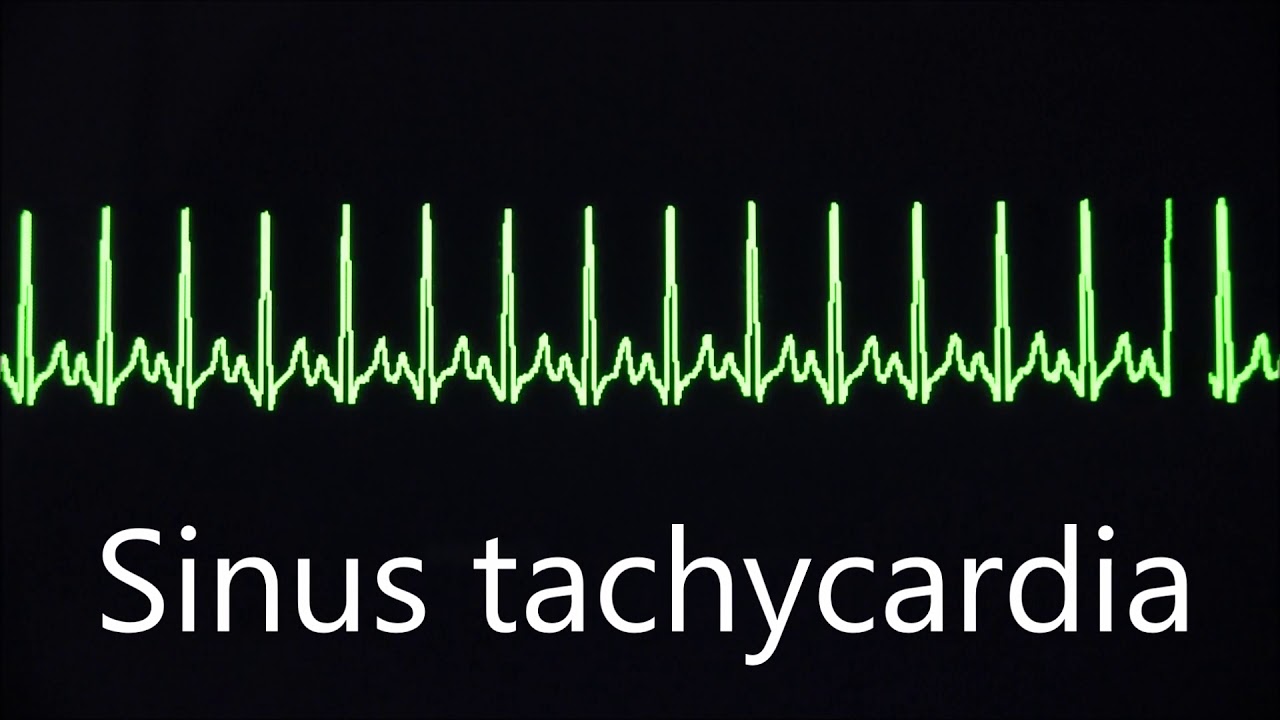 Синусовый ритм, брадикардия и тахикардия