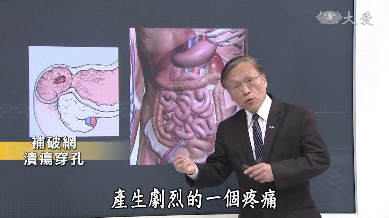 【大愛醫生館】20180816 - 補破網 潰瘍穿孔