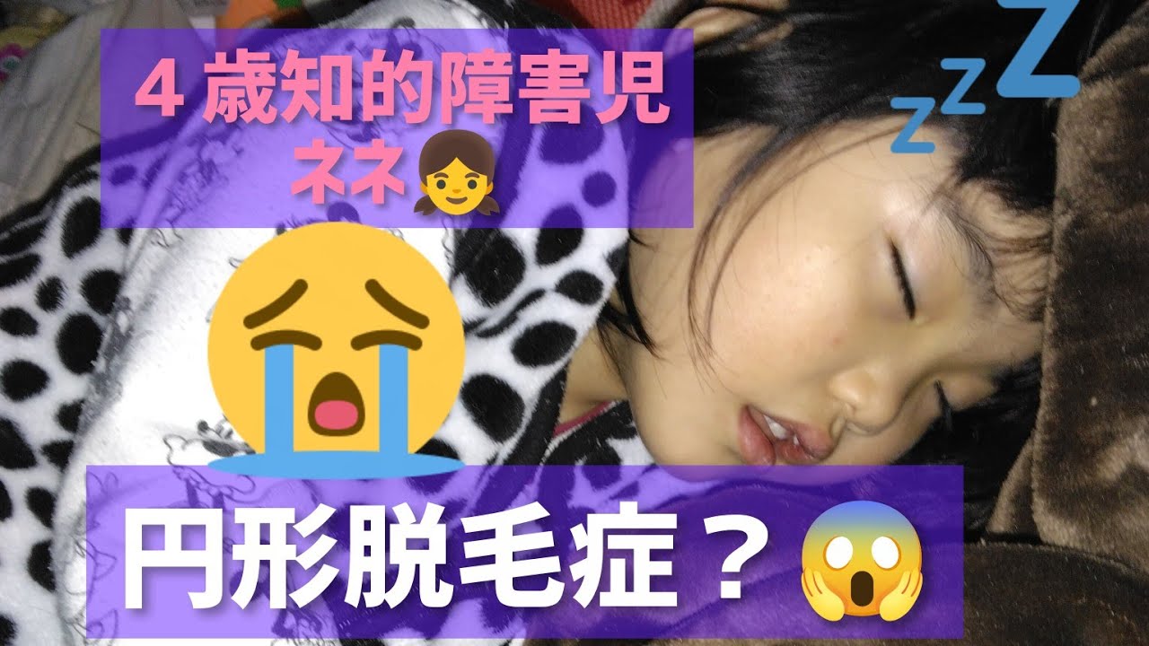 野生児ネネ👧円形脱毛症？😱【重度知的障害児】