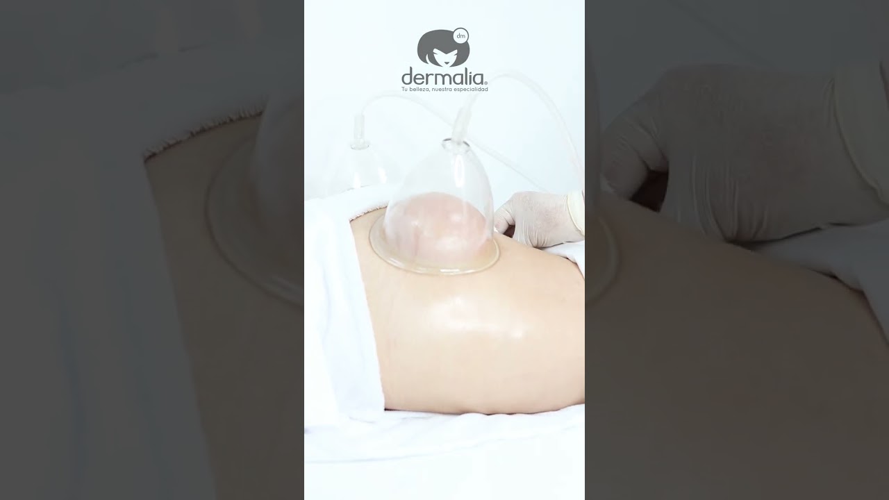 GLUTEAL VACUUM THERAPY