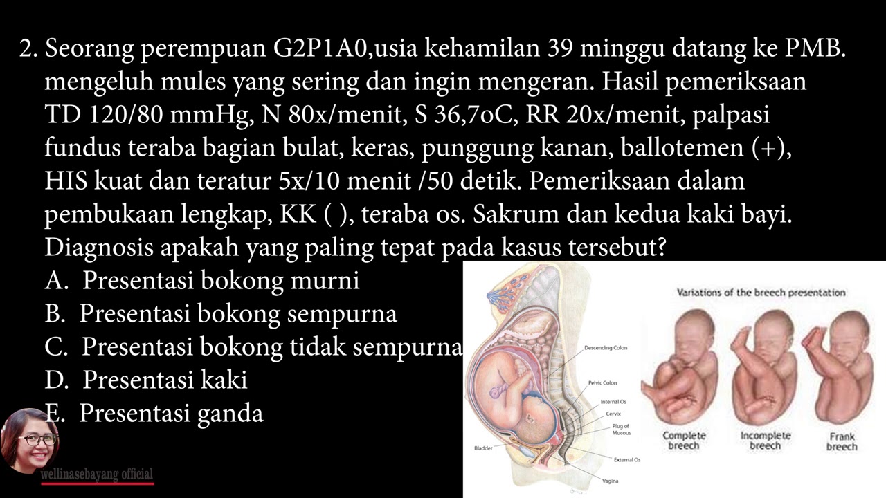 PEMBAHASAN SOAL UKOM KEBIDANAN 2020 Part 4 || STRES KEHAMILAN || PERSALINAN SUNGSANG