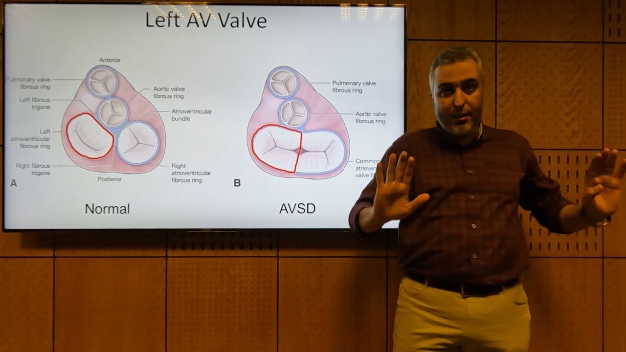 AVSD (AV Canal) - Hatem Hosny (2022)