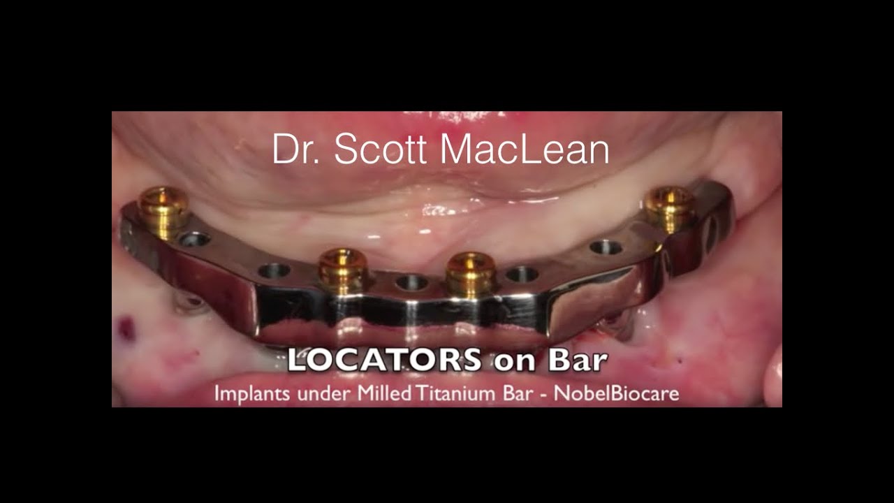 *NEW - Dental Implant Milled Bar Overdenture - Female Stud Attachments Change