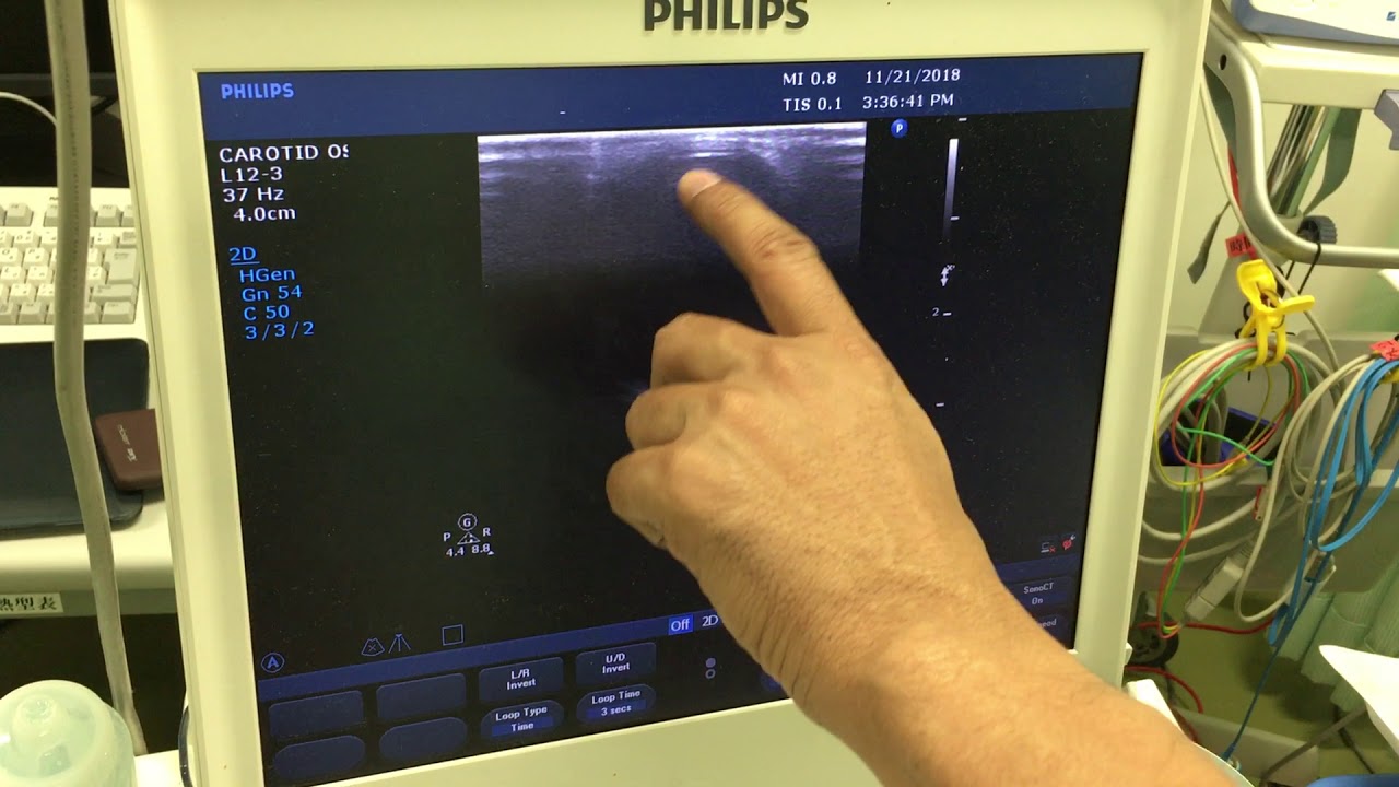 Dr Alza' Ultrasound Made Easy : Eye & Optic Nerve Sheath