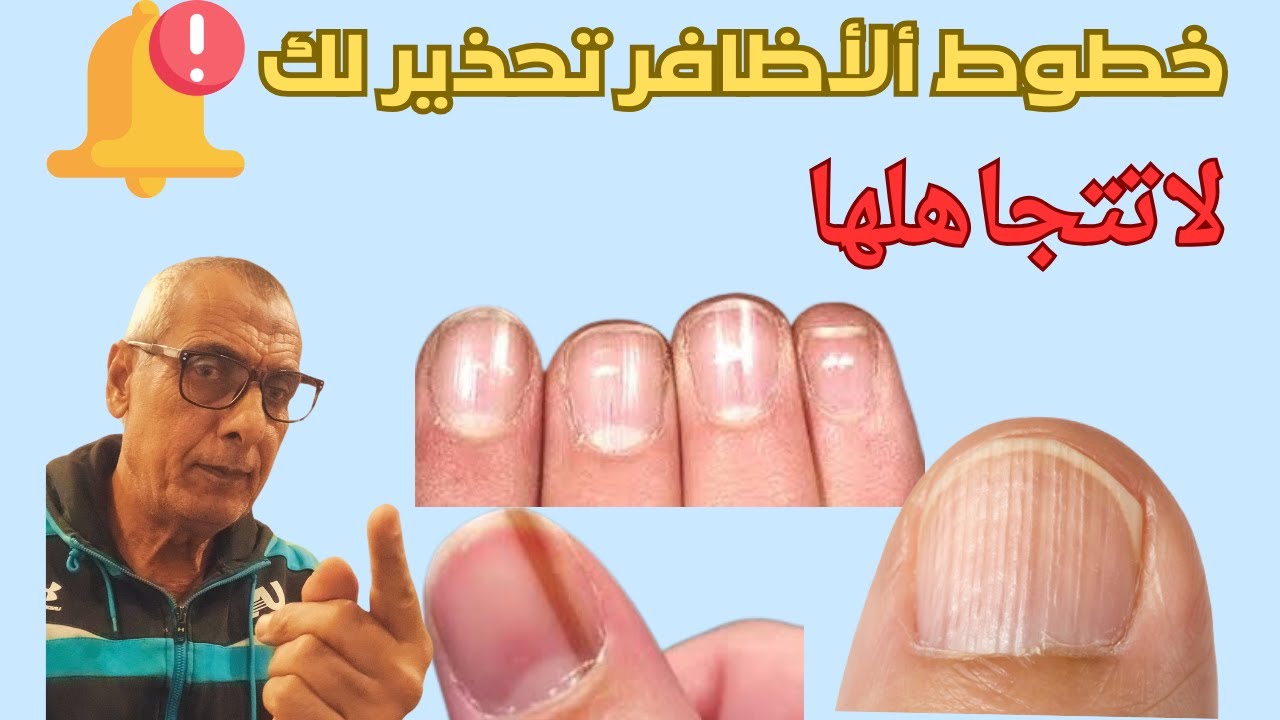 خطوط الأظافر تحذرك من مشاكل صحية محتملة