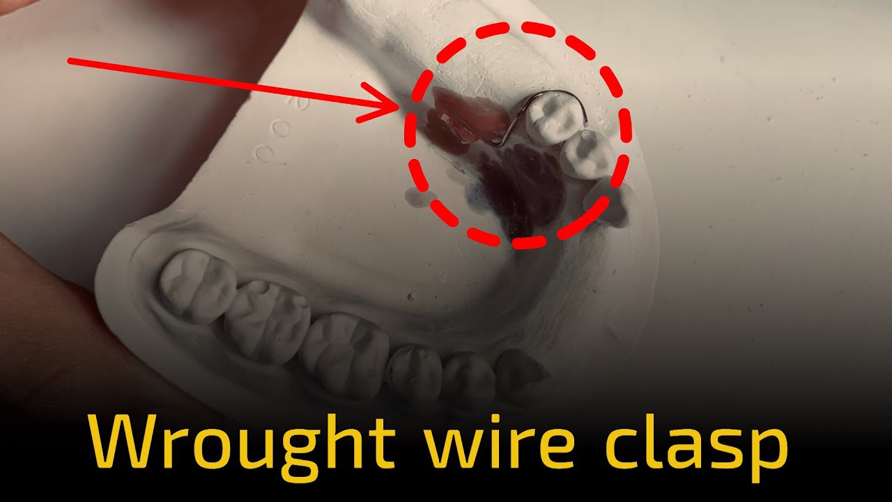 Wrought wire clasp by dr.ali