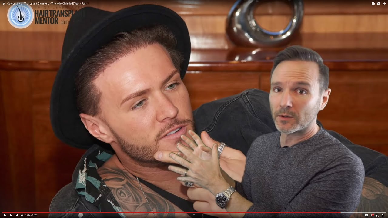 Can You Spot the Fake Hairline? Celebrity Hair Transplant Disasters