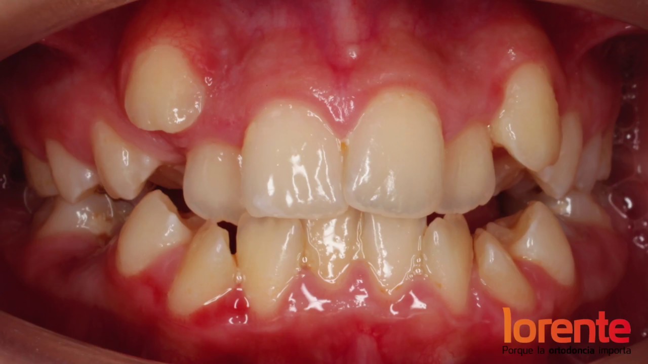 CASO REAL 25. Paciente con brackets metálicos. Antes-después
