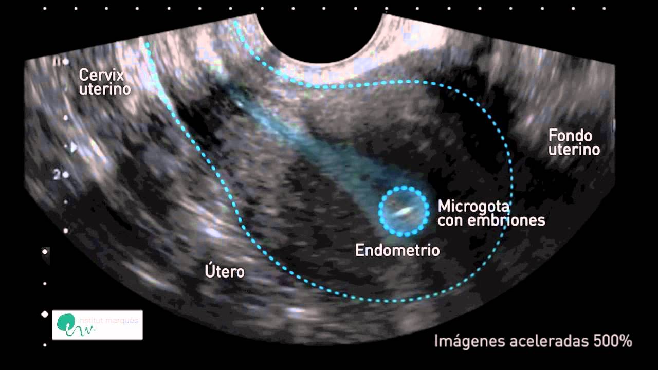 El útero mueve los embriones para que se implanten correctamente