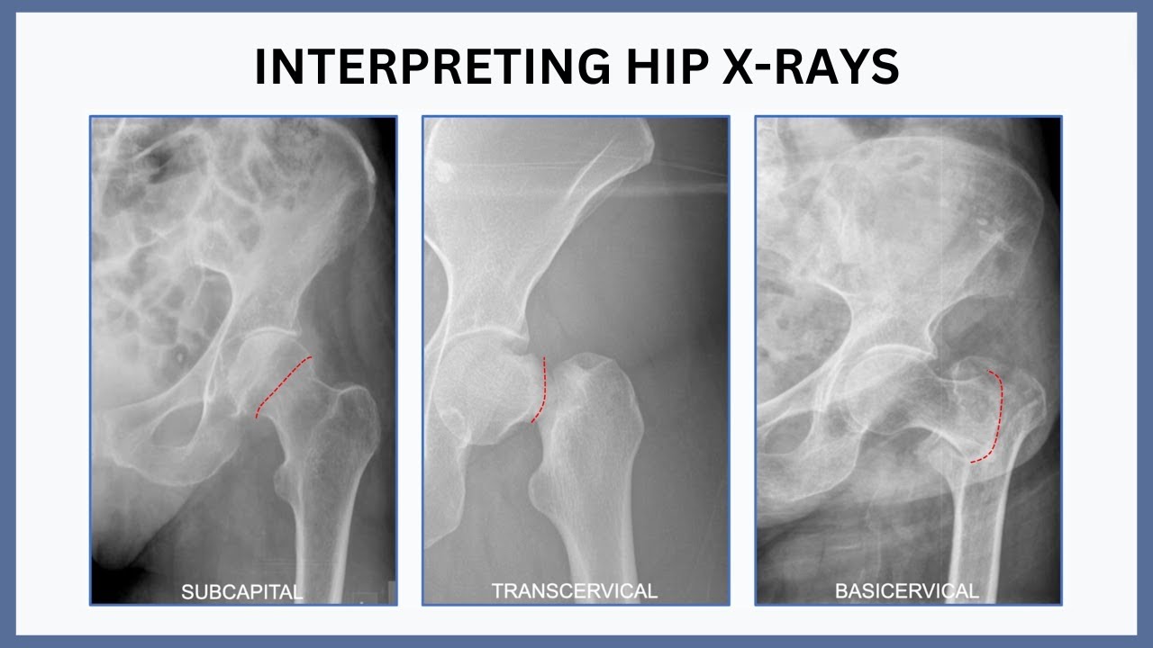 Interpreting Hip X-Rays