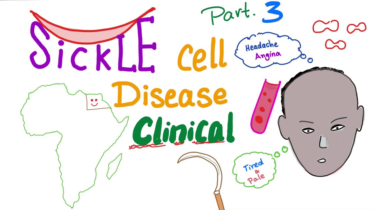 Sickle Cell Disease - Sickle Cell Anemia - Signs and Symptoms (Clinical Picture) - Part 3