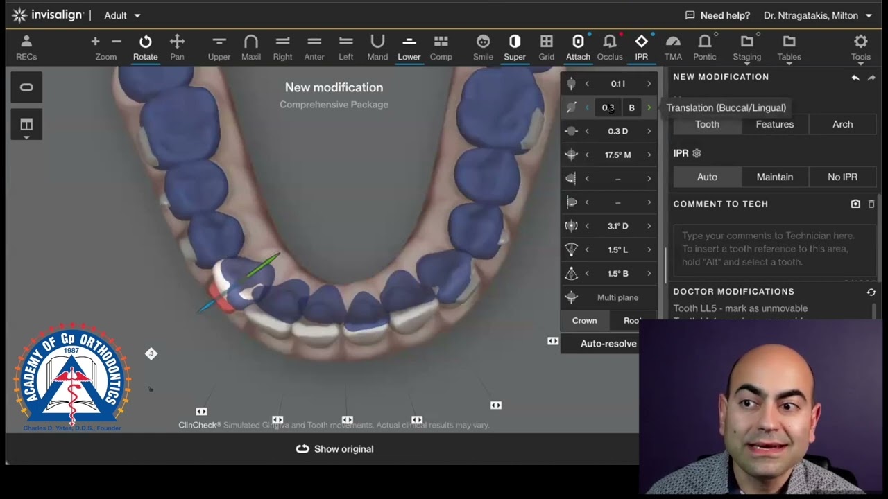 Monday Tip: Clincheck Modifications for your Invisalign Cases.