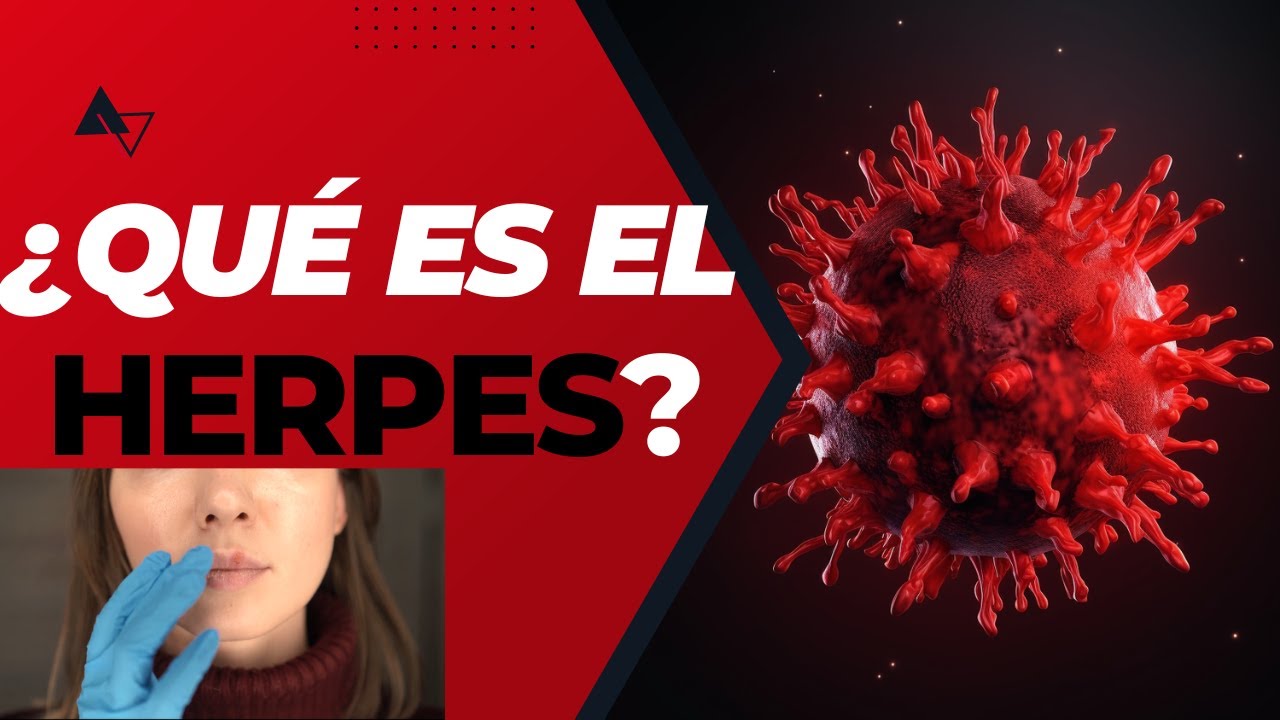 ¿Qué es el Herpes?