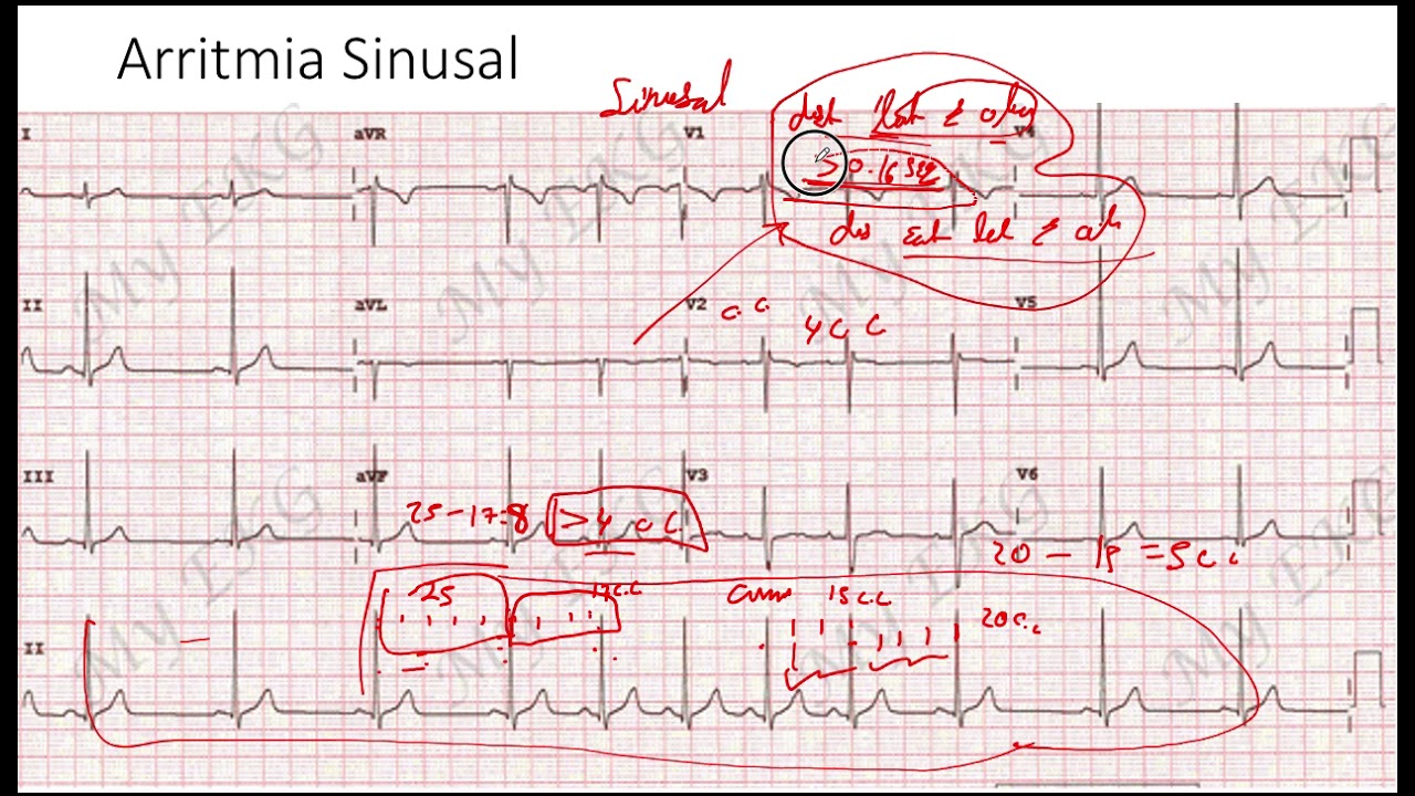 Arritmia Sinusal  EKG