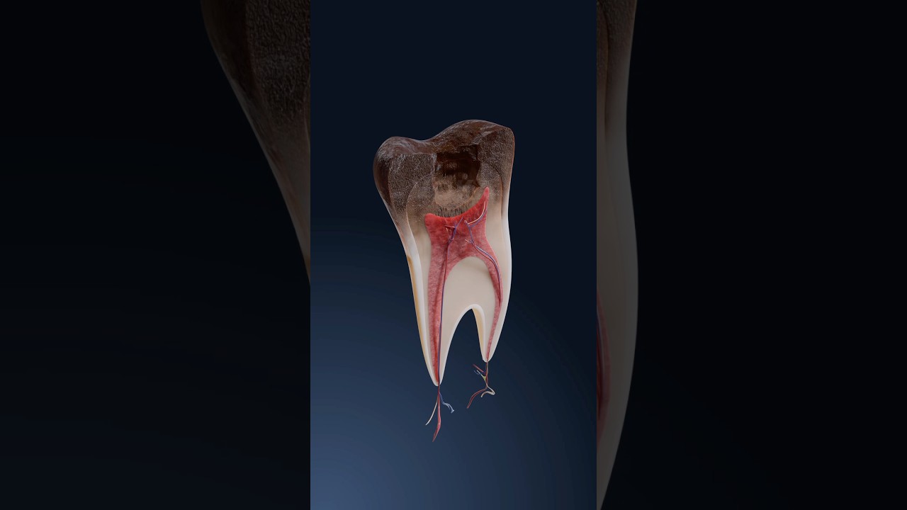 How cavities form: a 3D look at tooth decay progression