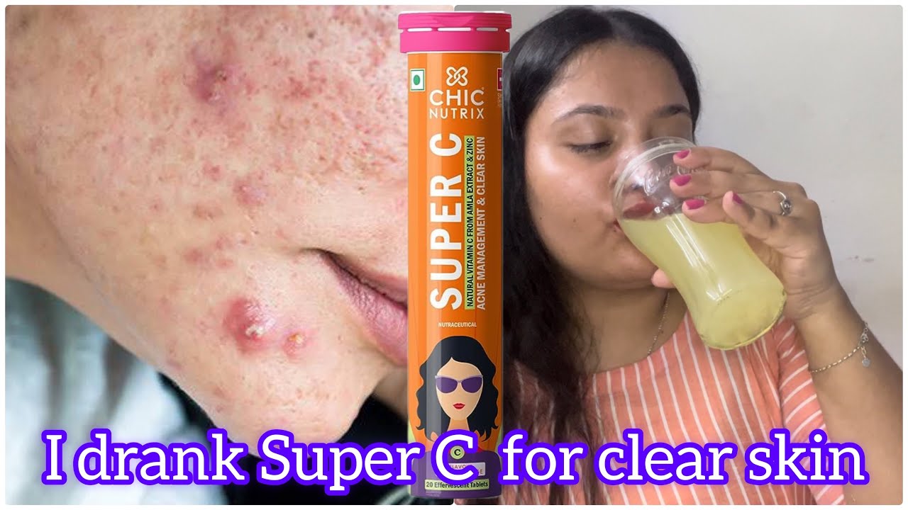 How to get clear skin|Secret for acne-free skin|vitamin-C|Chicnutrix Super C 