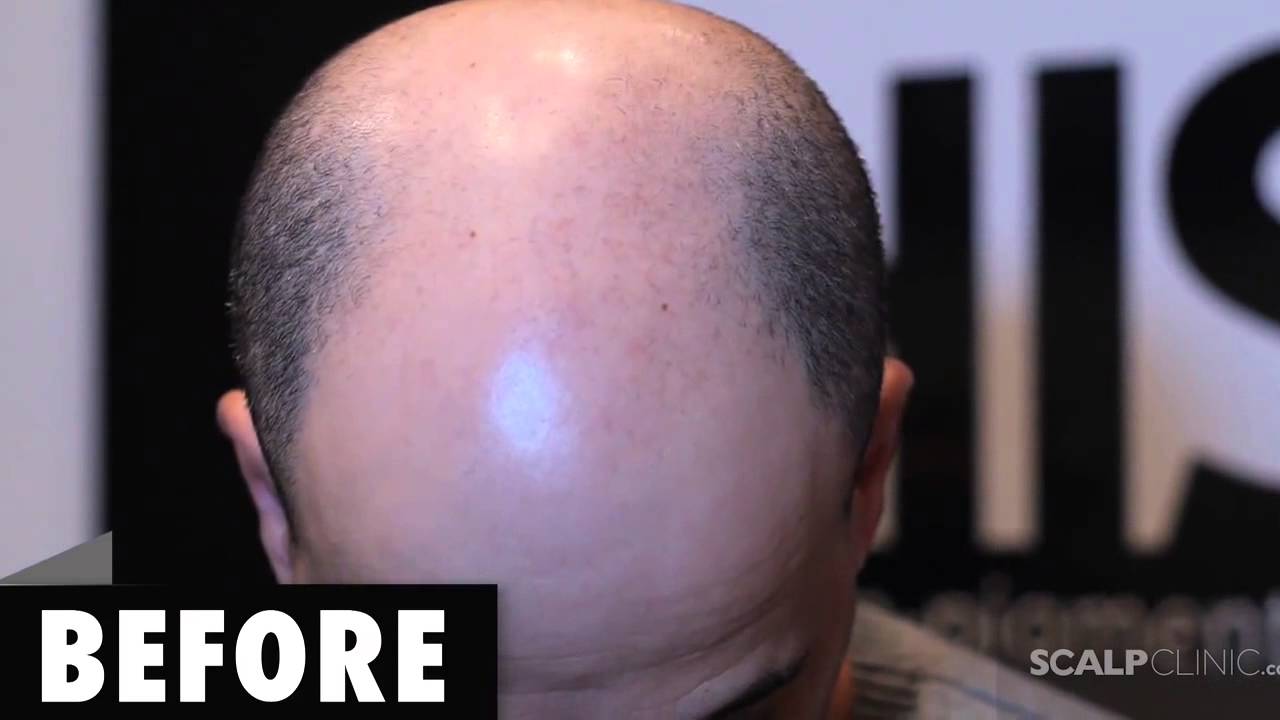 Natural Soft Hairline Scalp Micropigmentation - Hair Loss Scalp Clinic