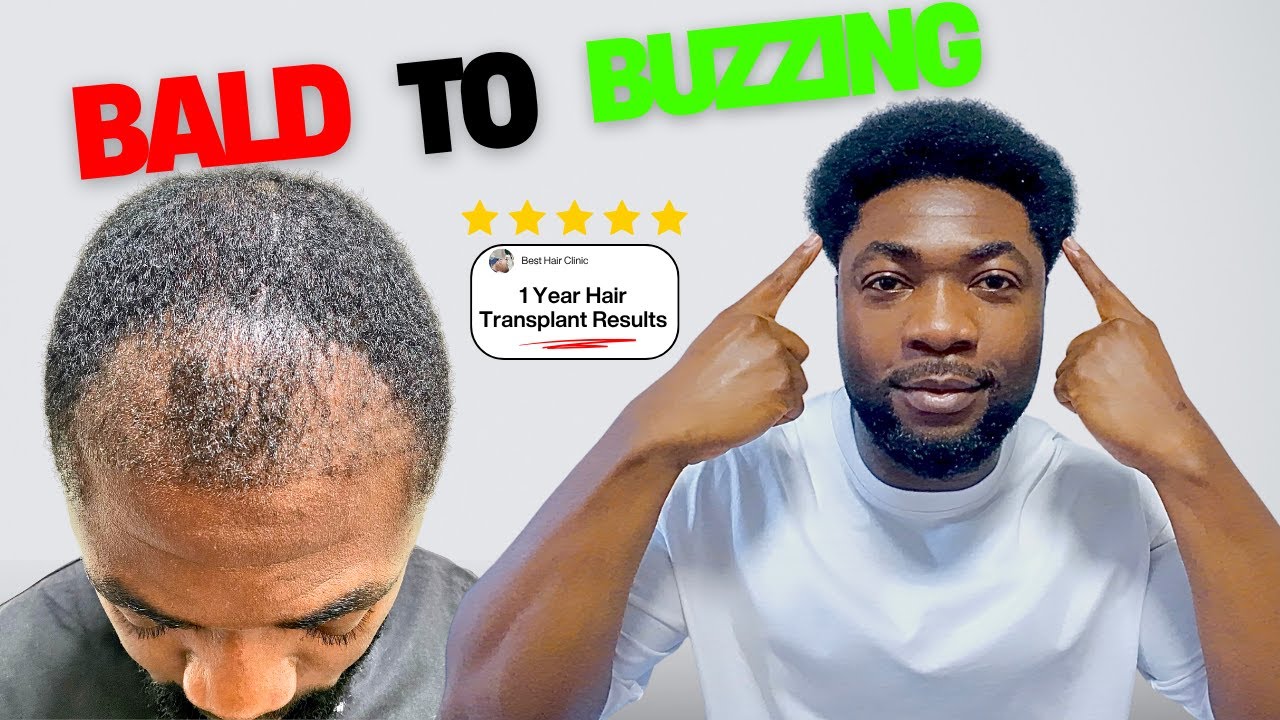 Hair Transplant in Turkey 1 Year Results (My SHOCKING Transformation) 👀🔥
