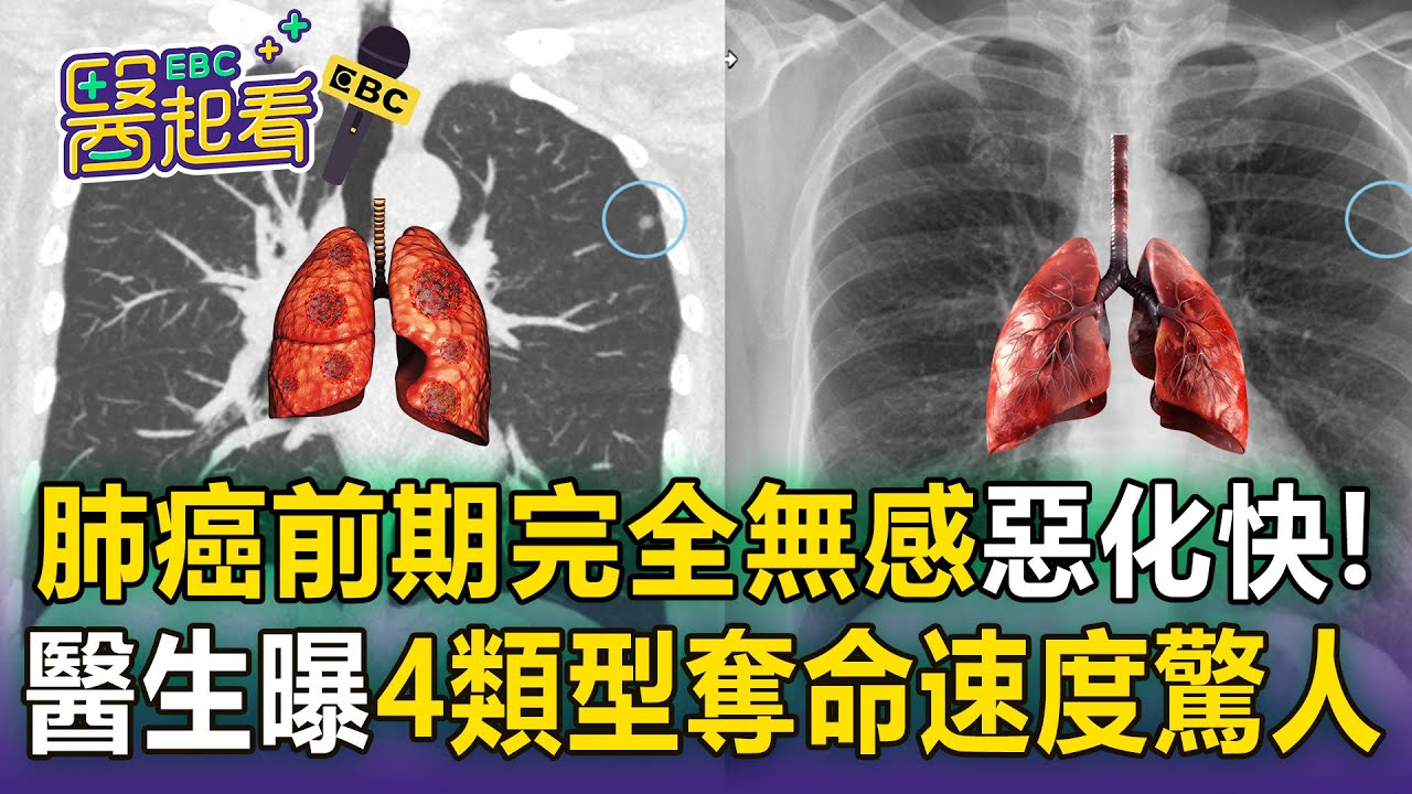 肺癌前期完全無感「咳不停驗出已末期」！醫生曝4類型「惡化快、奪命速度驚人」屬癌症王中王【醫起看】