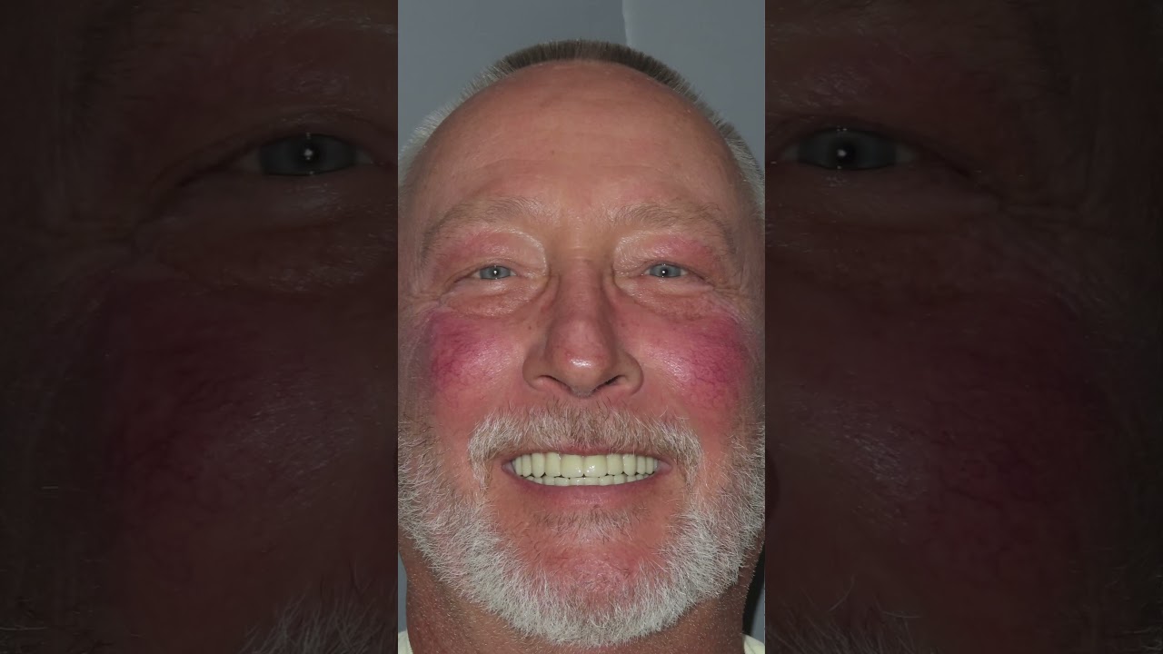 Before and after full mouth dental implants 