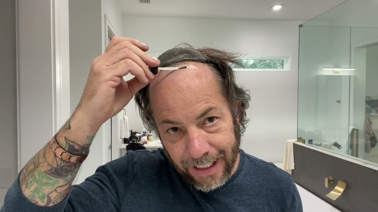Redo Your Hairline Hair System Hair Replacement 