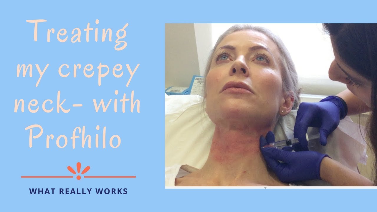 Neck rejuvenation with Profhilo & Aliaxin | Alice Hart-Davis