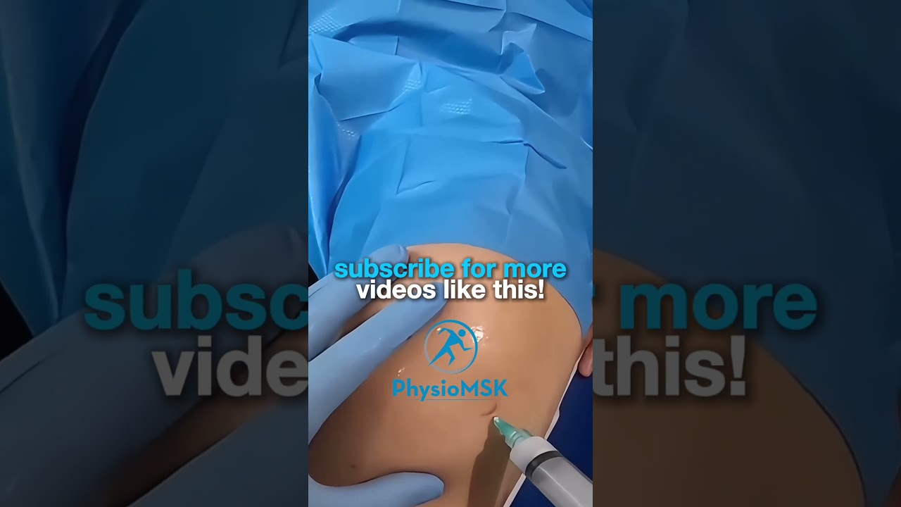Knee Injection Technique: The Anterior Approach (eyes of the knee)