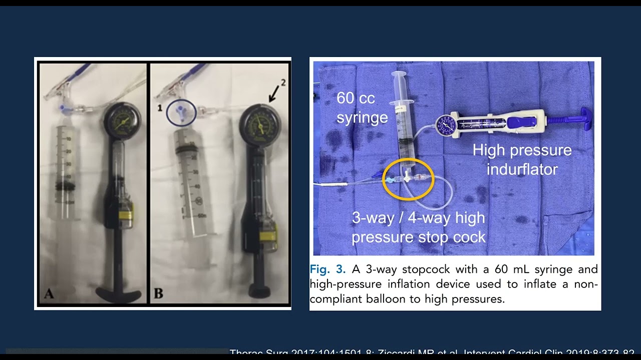 2023 TVI Бразилия: Перелом/ремоделирование баллонного клапана в ТАК в САК (клапан-в-клапан ТАК)