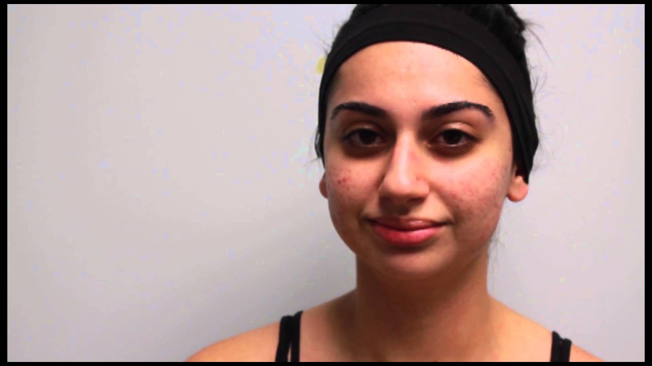 Newport Beach Laser Acne Scar Removal