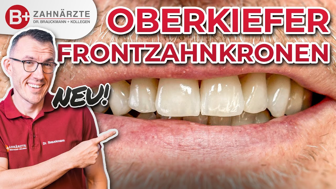 Neue Frontzahnkronen im Oberkiefer | Smile Makeover in Münster!