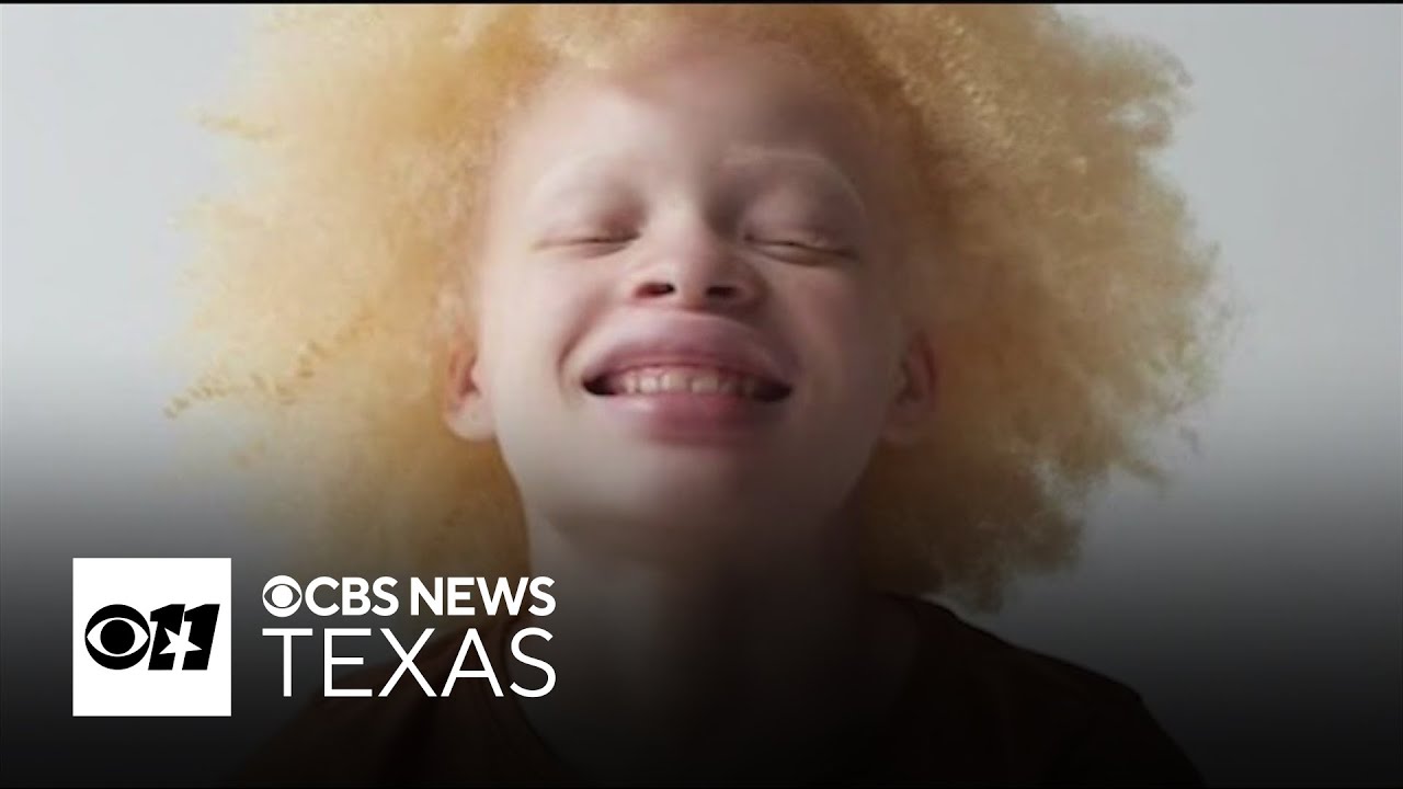 Royse City mother fights back against bullying of daughter with albinism