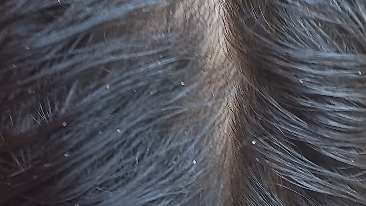 DICAS PARA TIRAR LÊNDEAS COM PALHA DE AÇO E LINHA