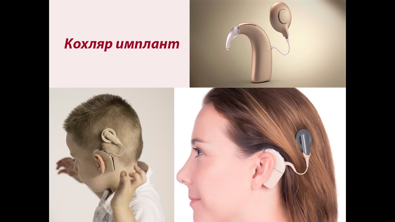 Кохляр имплант операцияси
