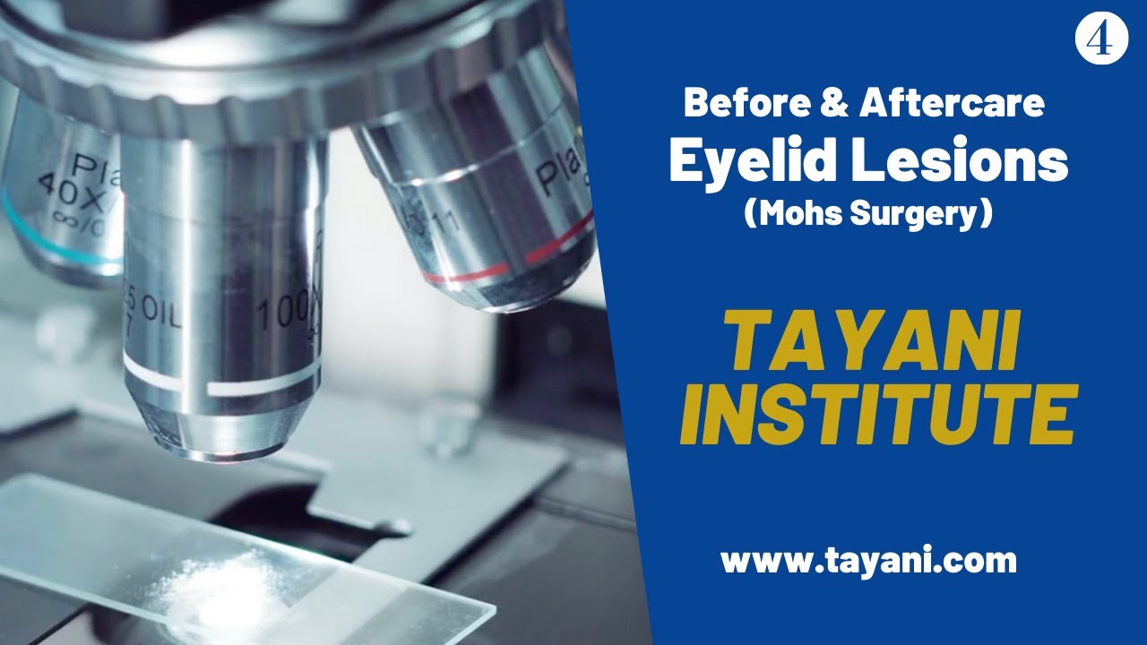 Before & After Eyelid Lesions (Mohs Surgery) | Tayani Institute