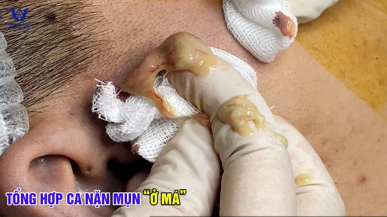 Tổng hợp những ca nặn mụn &aacute;p xe ở m&aacute; - Tại ph&ograve;ng kh&aacute;m da liễu HHV Clinic.