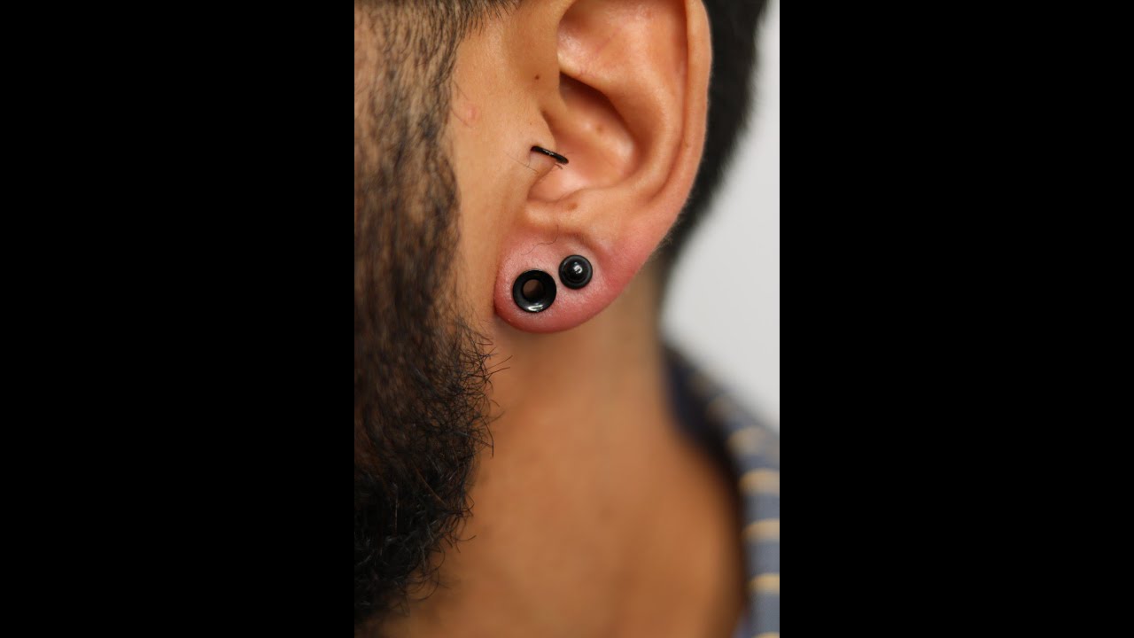 Dilatacion de lobulo de 0 a 6 mm