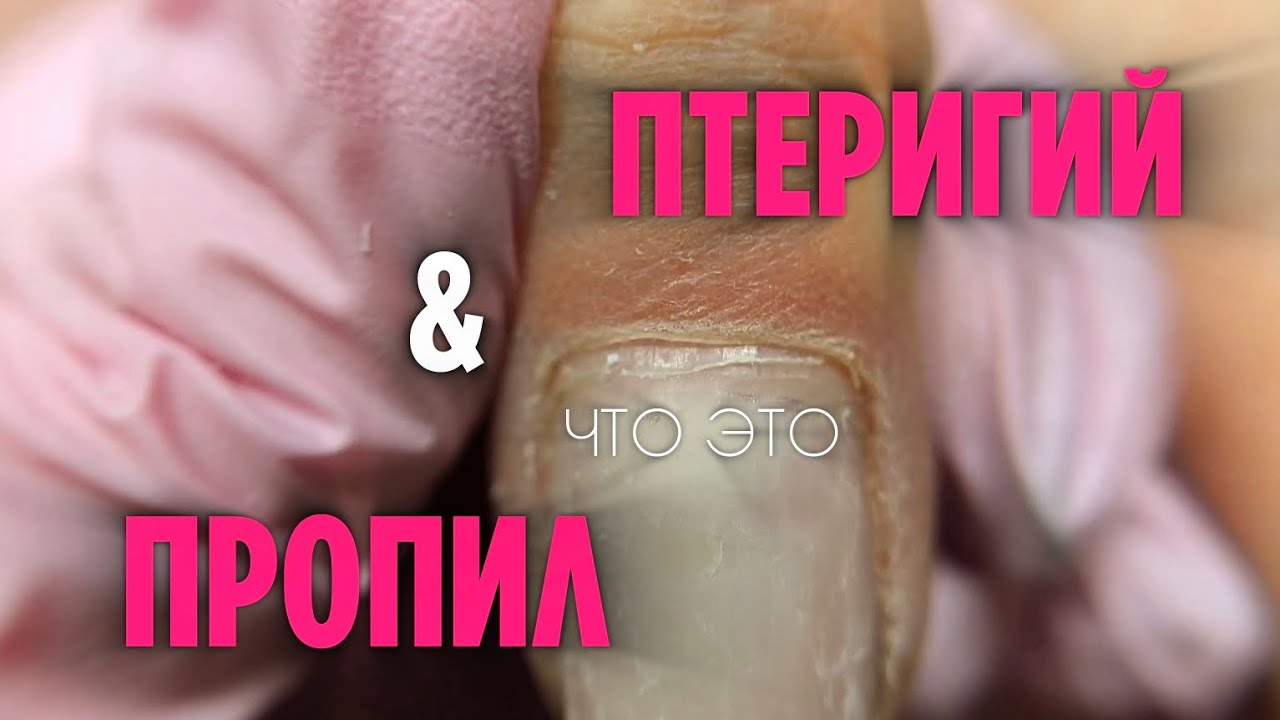 Перестаньте это спиливать! | Птеригий - это не пропил | Разбираем технику маникюра