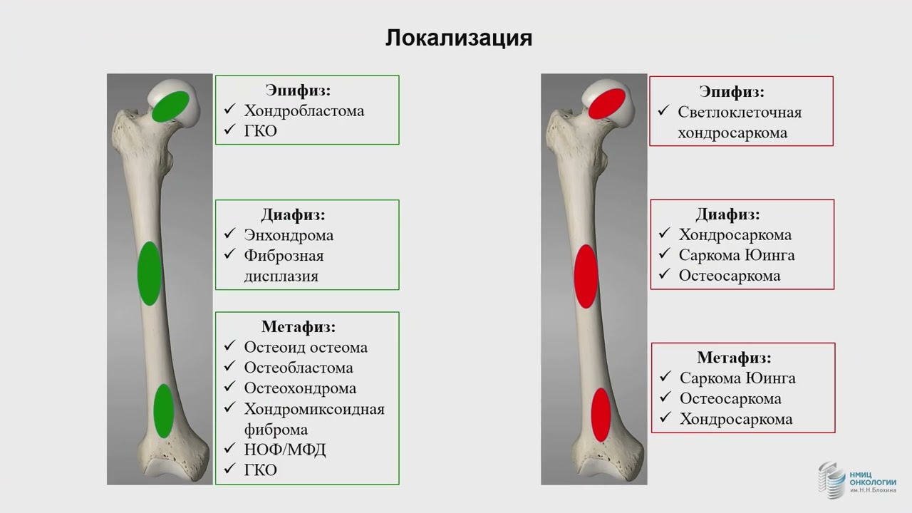 Диагностика опухолей костей  современный взгляд морфолога. Рогожин Д.В.