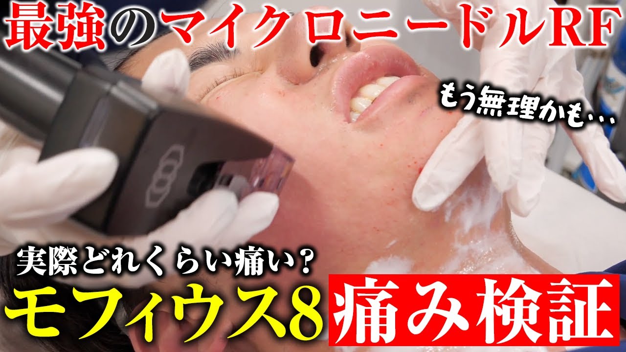 クレーターもたるみも治す！モフィウス8の痛み検証！実際に受けてレビューします。