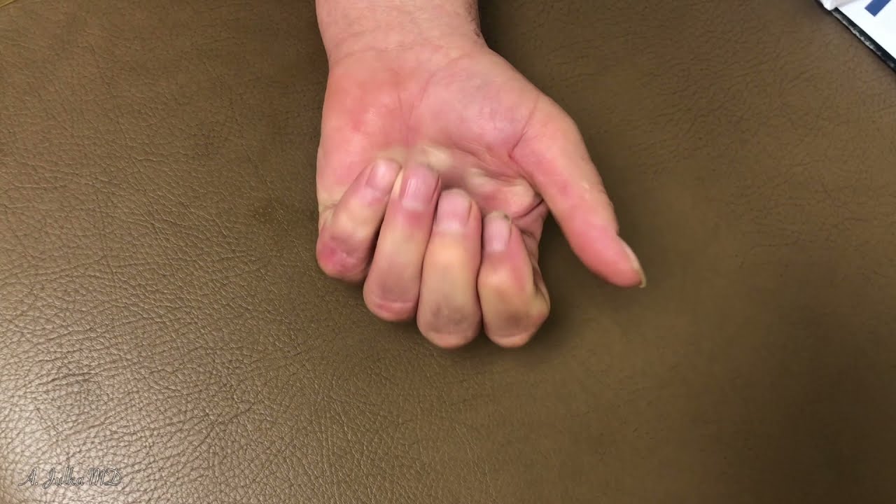 Severe Revision Dupuytren's Contracture Release Results Post Op