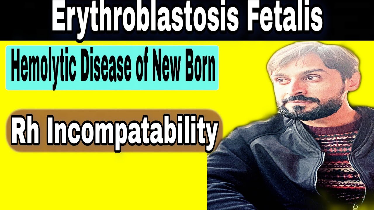 Erythroblastosis fetalis | Rh Incompatibility | Hemolytic Disease of New Born